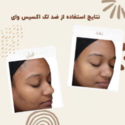 سرم ضد لک اکسیس وای اصل (به قیمت پخش) رفع جای جوش 10 before after axis y 6