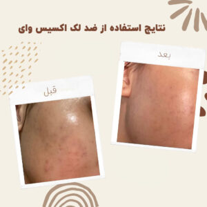 before after axis y 7