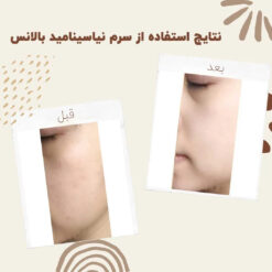سرم نیاسینامید بالانس (100%اصل+به قیمت پخش) 9 before after balance niacinamide 1