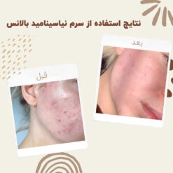 سرم نیاسینامید بالانس (100%اصل+به قیمت پخش) 7 before after balance niacinamide 3