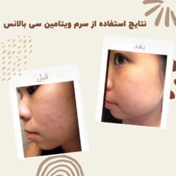 سرم ویتامین سی بالانس (100%اصل+به قیمت پخش) 9 before after balance vitaminc serum 1