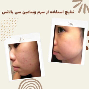 سرم ویتامین سی بالانس (100%اصل+به قیمت پخش) 13 before after balance vitaminc serum 1