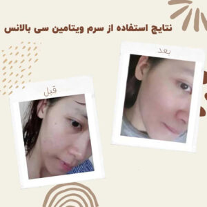 before after balance vitaminc serum 2