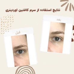 سرم کافئین اوردینری (100%اصل+به قیمت پخش) ضد تیرگی و پف دور چشم 26 before after cafeen 2