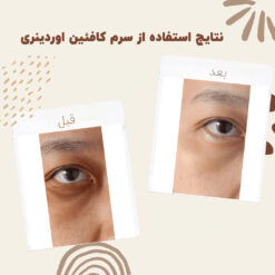 سرم کافئین اوردینری (100%اصل+به قیمت پخش) ضد تیرگی و پف دور چشم 25 before after cafeen 3