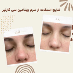 سرم ویتامین سی گارنیر (100%اصل+به قیمت پخش) آبرسان 12 before after garinier bright vitamin serum 02 min