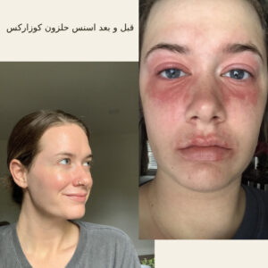 اسنس حلزون کوزارکس (100% اصل+به قیمت پخش) 57 before after hair oridinary 18 510x510 9