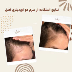 سرم ضد ریزش مو اوردینری مولتی پپتید (100%اصل+به قیمت پخش) 34 before after hair oridinary 4