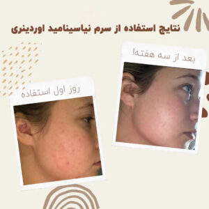 before after niasinamid ordinary