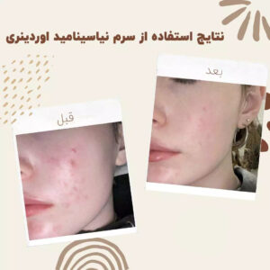 before after niasinamid15