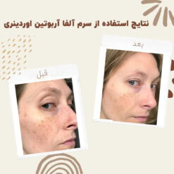 سرم آلفا آربوتین اوردینری (100%اصل+به قیمت پخش) ضد لک 24 before after ordinary alpha arbutin 01 min
