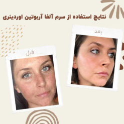 سرم آلفا آربوتین اوردینری (100%اصل+به قیمت پخش) ضد لک 23 before after ordinary alpha arbutin 02 min