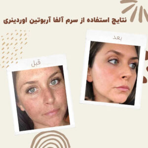 before after ordinary alpha arbutin 02 min