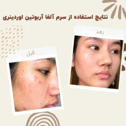 سرم آلفا آربوتین اوردینری (100%اصل+به قیمت پخش) ضد لک 22 before after ordinary alpha arbutin 03 min