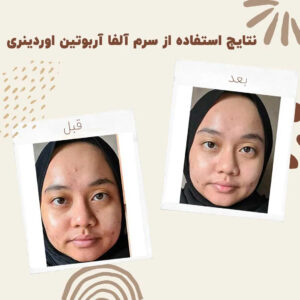 before after ordinary alpha arbutin 04 min