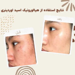 سرم آبرسان هیالورونیک اسید اوردینری (100%اصل+به قیمت پخش) پوست چرب خشک مختلط 8 before after ordinary hyaluronic acid serum 1
