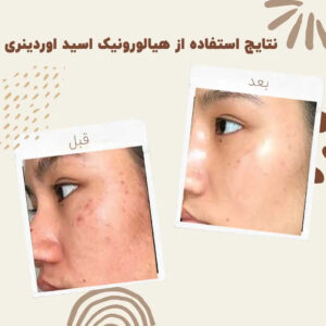 before after ordinary hyaluronic acid serum 1