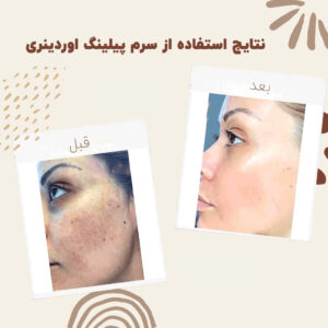 before after peeling 1