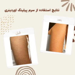 سرم پیلینگ اوردینری قرمز (100%اصل+ارسال فوری) لایه بردار 24 before after peeling 1 min