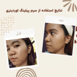 سرم پیلینگ اوردینری قرمز (100%اصل+ارسال فوری) لایه بردار 23 before after peeling 2