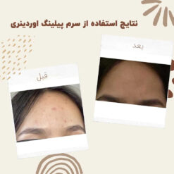 سرم پیلینگ اوردینری قرمز (100%اصل+ارسال فوری) لایه بردار 22 before after peeling 2 min