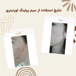 سرم پیلینگ اوردینری قرمز (100%اصل+ارسال فوری) لایه بردار 21 before after peeling 3