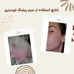 سرم پیلینگ اوردینری قرمز (100%اصل+ارسال فوری) لایه بردار 20 before after peeling 3 min