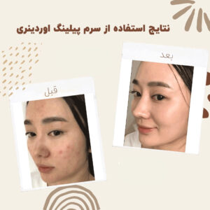 before after peeling 4