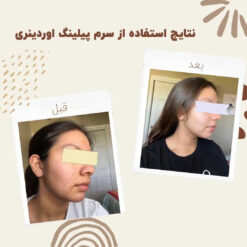 سرم پیلینگ اوردینری قرمز (100%اصل+ارسال فوری) لایه بردار 18 before after peeling 4 min 1
