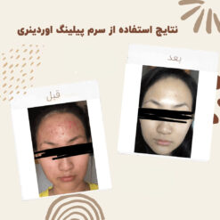 سرم پیلینگ اوردینری قرمز (100%اصل+ارسال فوری) لایه بردار 17 before after peeling 5