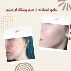 سرم پیلینگ اوردینری قرمز (100%اصل+ارسال فوری) لایه بردار 16 before after peeling 6