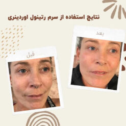سرم رتینول اوردینری (100%اصل+به قیمت پخش) 14 before after retinol 1