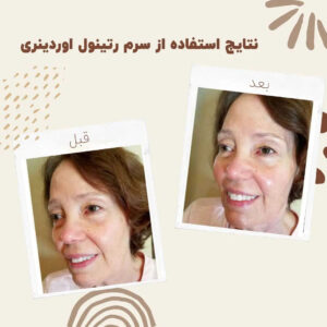 before after retinol 2