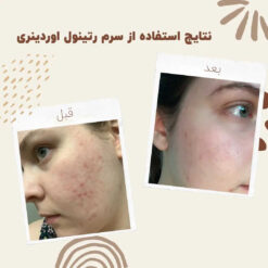 سرم رتینول اوردینری (100%اصل+به قیمت پخش) 12 before after retinol 3