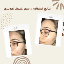 سرم رتینول اوردینری (100%اصل+به قیمت پخش) 11 before after ritinol 1 min