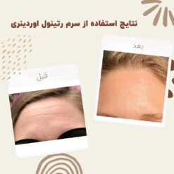 سرم رتینول اوردینری (100%اصل+به قیمت پخش) 10 before after ritinol 2 min