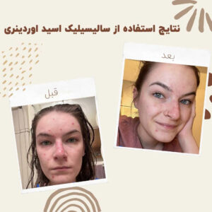 before after salicylic acid 1 min