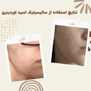 before after salicylic acid 2 min