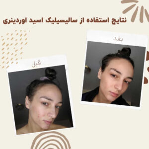 before after salicylic acid 3 min