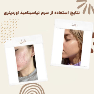 before after zhinora niasin 12