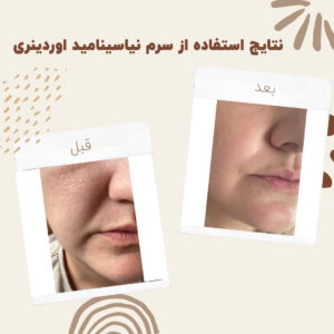 before after zhinora niasin 13