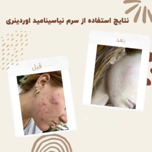 before after zhinora niasin 14