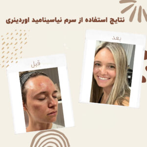 before after zhinora niasin 15