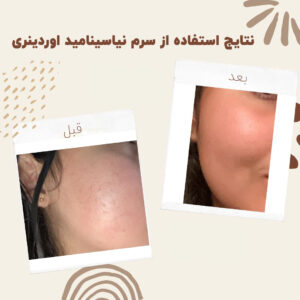 before after zhinora niasin 17