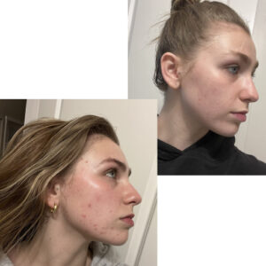 before after zhinora ordinary salicylic acid solut 1