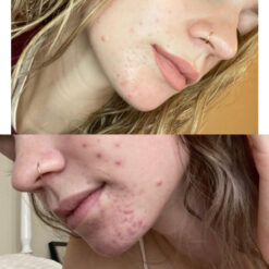 سرم رتینول سراوی پوست چرب و مختلط (100%اصل+به قیمت پخش) آبی ضد جوش 33 before after zhinora ordinary salicylic acid solut 10