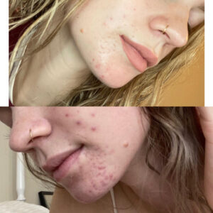 before after zhinora ordinary salicylic acid solut 10