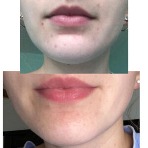 before after zhinora ordinary salicylic acid solut 11