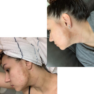 before after zhinora ordinary salicylic acid solut 12