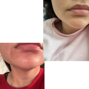 before after zhinora ordinary salicylic acid solut 13 1